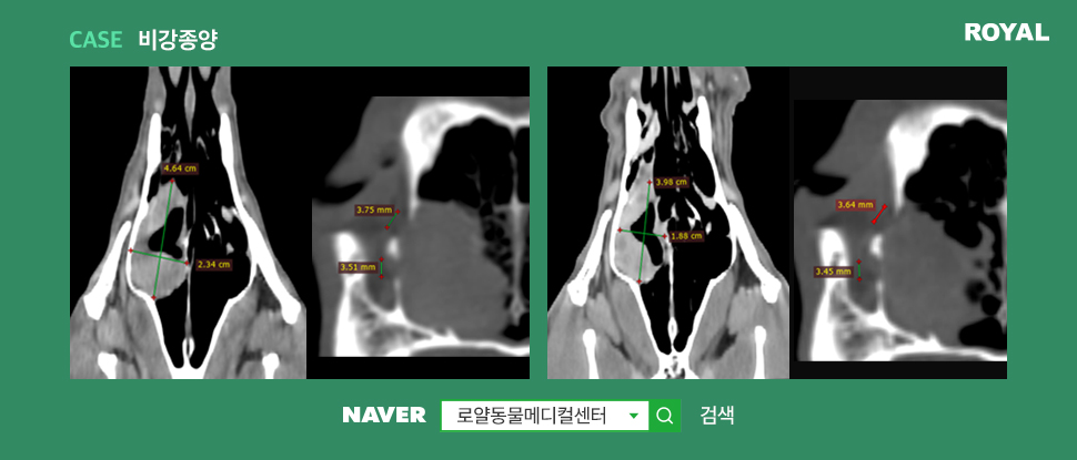 비강종양