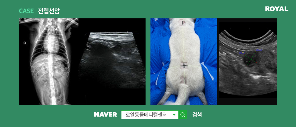 전립선암