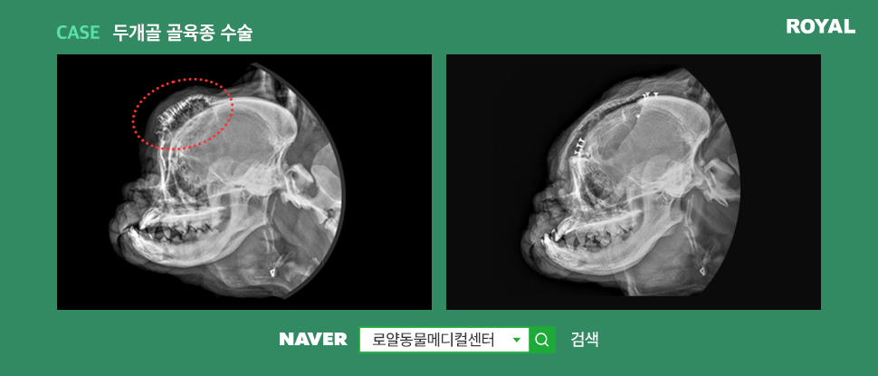 두개골 골육종